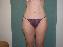 Liposuction Picture