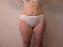 Liposuction Picture