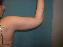Body Contouring After Major Weight Loss Picture