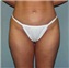 Liposuction Picture