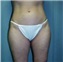 Liposuction Picture