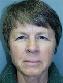 Eyelid Surgery Picture