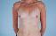 Breast Augmentation Picture
