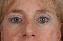 Eyelid Surgery Picture