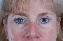 Eyelid Surgery Picture