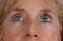 Eyelid Surgery Picture