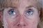 Eyelid Surgery Picture