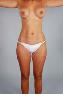 Liposuction Picture