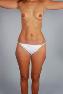 Liposuction Picture