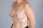 Breast Reconstruction Picture