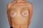 Breast Reconstruction Picture