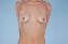Breast Reconstruction Picture