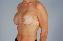 Breast Reconstruction Picture