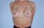 Breast Reconstruction Picture