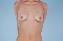 Breast Reconstruction Picture