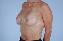 Breast Reconstruction Picture