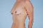 Breast Reconstruction Picture