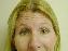 Botulinum Toxin Picture
