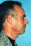 Injectable Fillers Picture