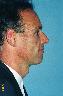 Injectable Fillers Picture
