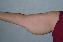 Arm Lift Picture