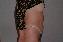 Liposuction Picture