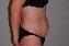 Liposuction Picture