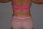 Liposuction Picture