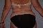 Liposuction Picture
