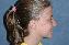 Ear Surgery Picture