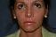 Injectable Fillers Picture