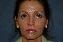 Injectable Fillers Picture