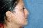 Nose Surgery Picture