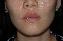 Injectable Fillers Picture