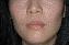 Injectable Fillers Picture