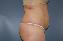 Tummy Tuck Picture