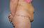 Tummy Tuck Picture