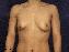 Breast Augmentation Picture