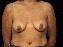 Breast Lift Picture