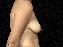Breast Lift Picture