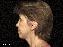 Facelift Picture