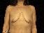 Breast Lift Picture