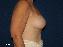 Breast Lift Picture