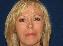 Injectable Fillers Picture