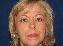 Injectable Fillers Picture