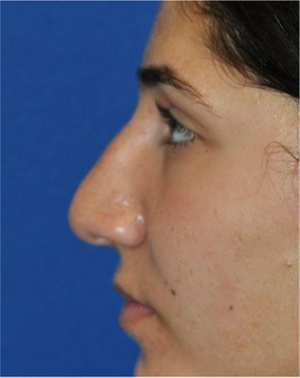 Rhinoplasty Before And After Photos By Ali Totonchi MD Lyndhurst OH