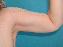 Arm Lift Picture