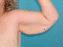 Arm Lift Picture