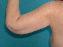 Arm Lift Picture