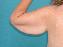Arm Lift Picture